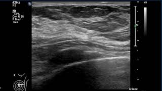 Breast Ultrasound  normal anatomy [upl. by Jalbert197]