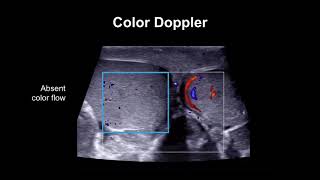 Diagnosing testicular torsion [upl. by Alana]