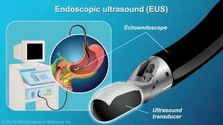 Understanding EUSFNA [upl. by Donnell361]