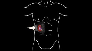 POCUS  Basic Renal Ultrasound [upl. by Kassi]