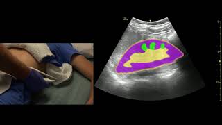 Kidney Ultrasound Scanning Technique [upl. by Drucy450]