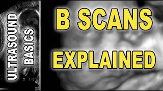 ultrasoundsonogram  B scans explained [upl. by Kin]