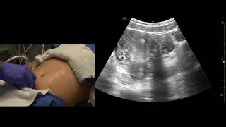 Transabdominal Pelvis Ultrasound Scanning Techniques [upl. by Esmerelda]