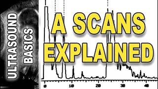 ultrasound  A scans explained [upl. by Eenyaj]