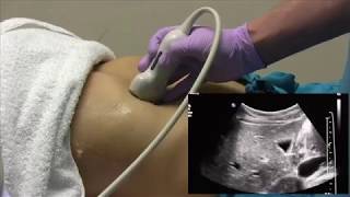 How I do it Ultrasound of the Abdomen [upl. by Cheadle]